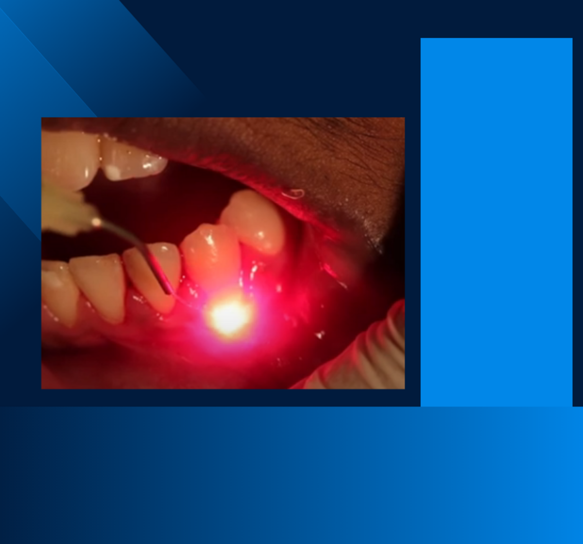 Fotodynamická terapie