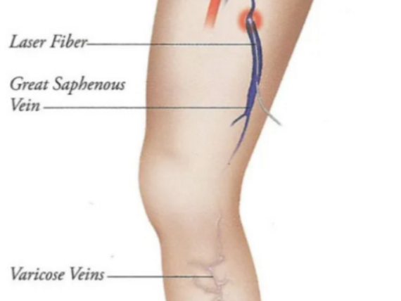 ELVT endovenózní laserová léčba