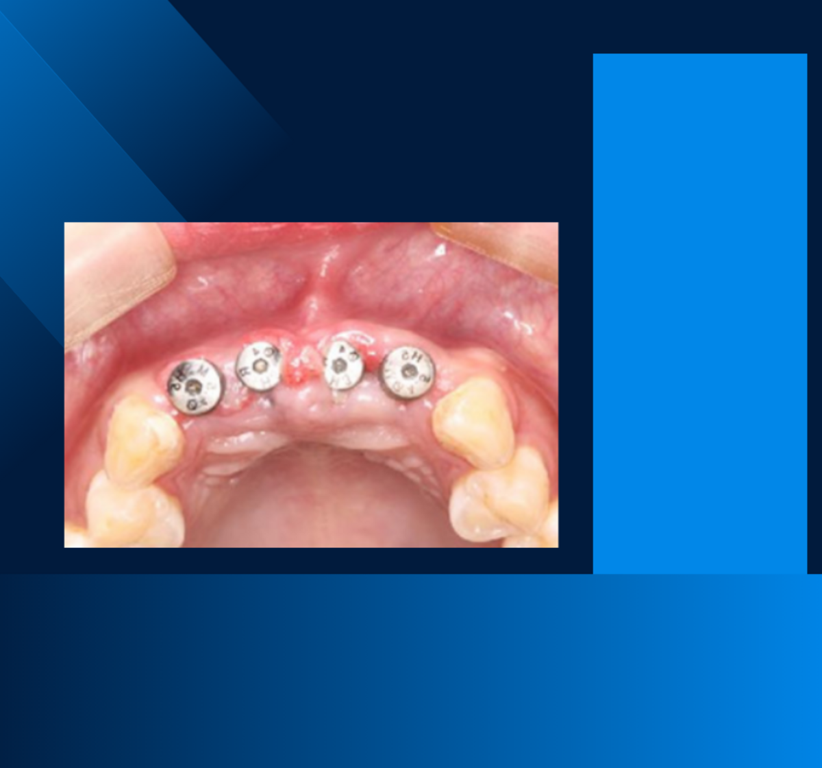 Odhalení implantátu