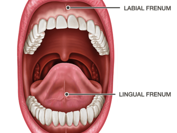 Linguální frenulektomie 