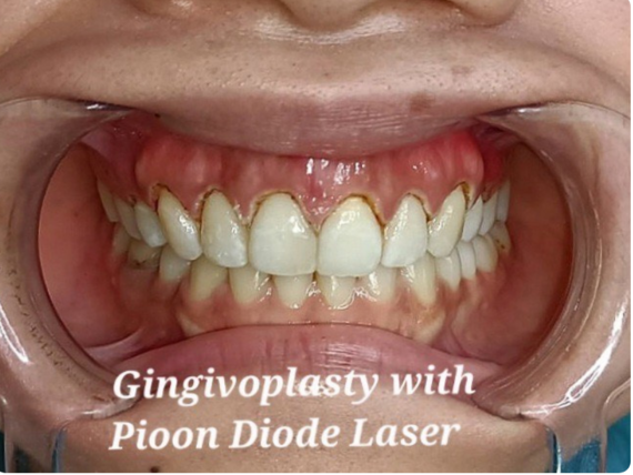 Výhody gingivoplastiky