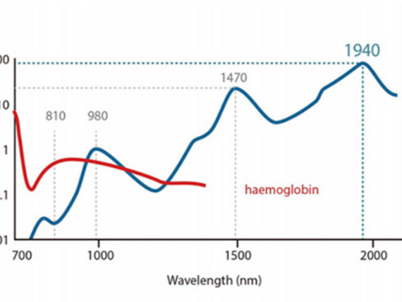 EVLT endovenózní laserová terapie